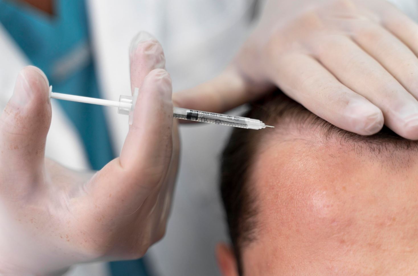 Saç Kök Hücre Tedavisi